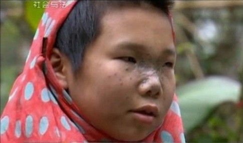 央視報道天妃整形援助回龍鎮(zhèn)“槍傷小女孩”